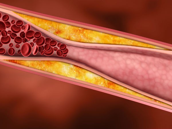 Giảm hàm lượng cholesterol: Hàm lượng cholesterol quá cao có thể gây tắc động mạch và giảm lượng máu lưu thông đến các cơ quan trong cơ thể. Gạo lứt chứa chất GABA giúp giảm hàm lượng cholesterol hiệu quả.
