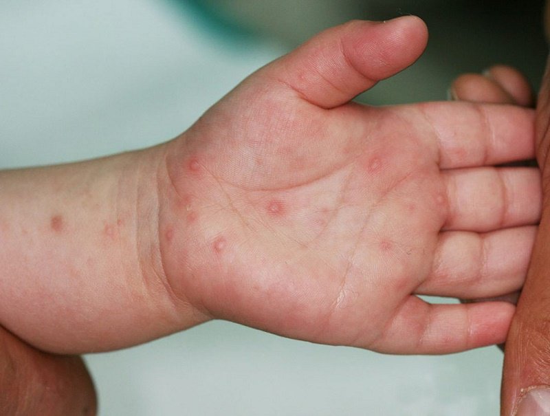 Trẻ bị tay chân miệng thường xuất hiện các vết nổi mụn nước ở lòng bàn tay.