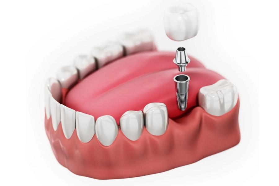 Implant là một phương pháp được thực hiện độc lập, không ảnh hưởng đến các răng khác.